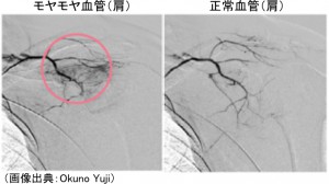 肩のモヤモヤ血管と正常血管