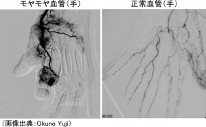手のモヤモヤ血管と正常血管