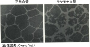 正常血管とモヤモヤ血管のインク実験