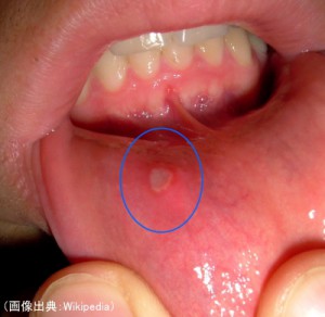 アフタ性口内炎