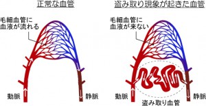 正常な血管と盗み取り現象が起きた血管