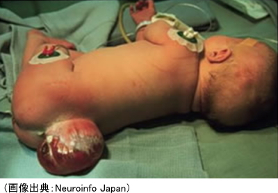 脊髄髄膜瘤の赤ちゃん