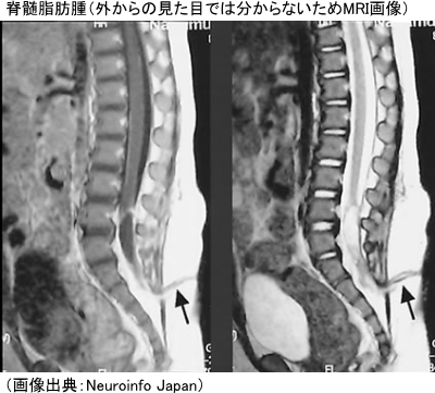 脊髄脂肪腫の赤ちゃんのMRI画像