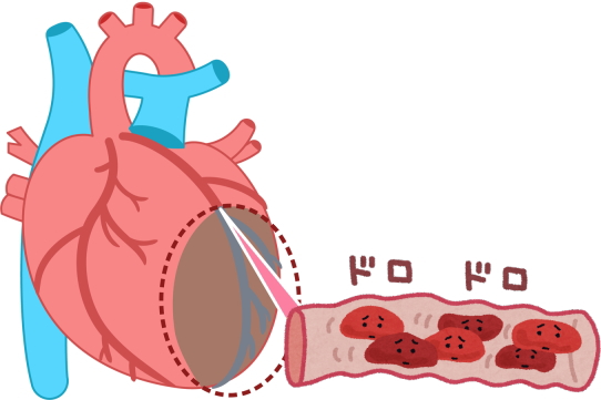 心臓の血管がドロドロ血